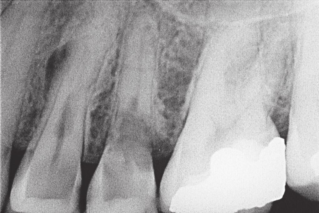 398 A D B E C F G Fig. 1 A, Pre-operative periapical radiograph showing extensive resorption of the upper left second premolar tooth.