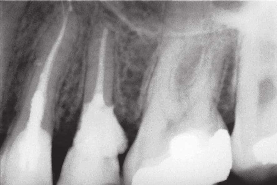 B, Working length determination of the upper left second premolar tooth.