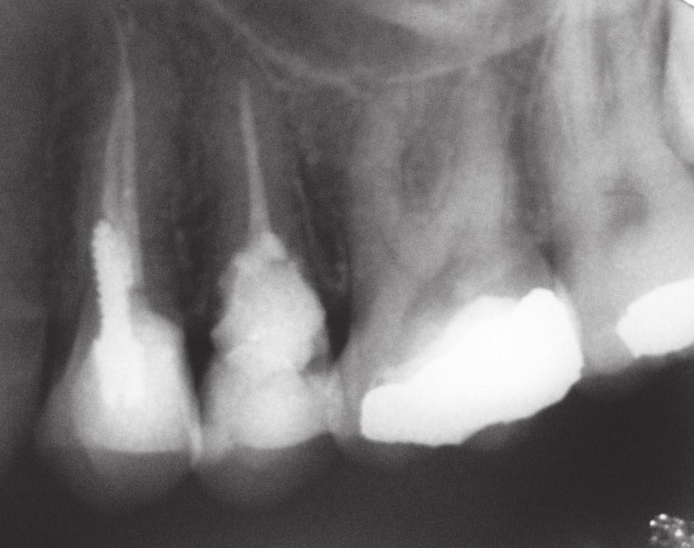 E, A 12-month follow-up radiograph showing the excellent periodontal condition of the upper left second premolar tooth and clear evidence