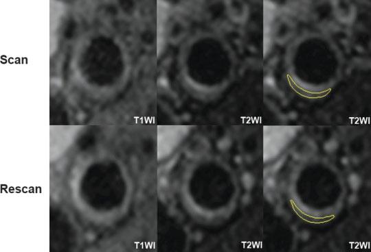174 Li et al. Figure 3. The typical image pattern of lipid rich/necrotic core (LR/NC) is isointensity on T1-weighted imaging (T1WI) and low intensity on T2- weighted imaging (T2WI).