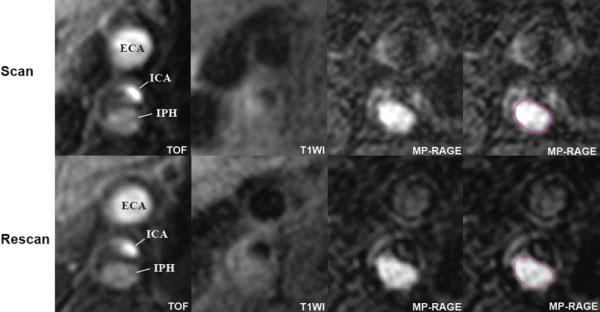 3T Carotid MRI Reproducibility 175 Figure 5.
