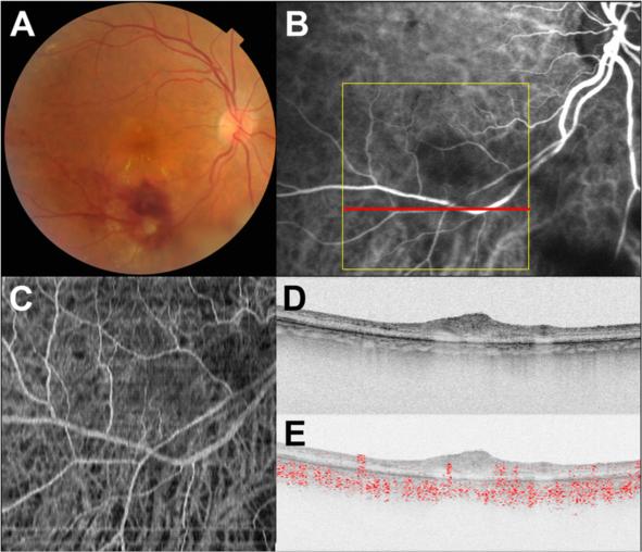 Miura et al. BMC Ophthalmology (2015) 15:79 Page 4 of 5 Fig. 3 Doppler OCT images of the right eye of Subject 2 after direct laser photocoagulation at the retinal macroaneurysm.