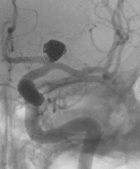 Angiography Acute