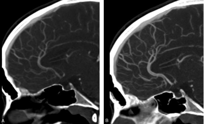 Fig 2. Corresponding sagittal sections of STS MPR (A) and MIP (B) reformations in the same 63-year-old man.