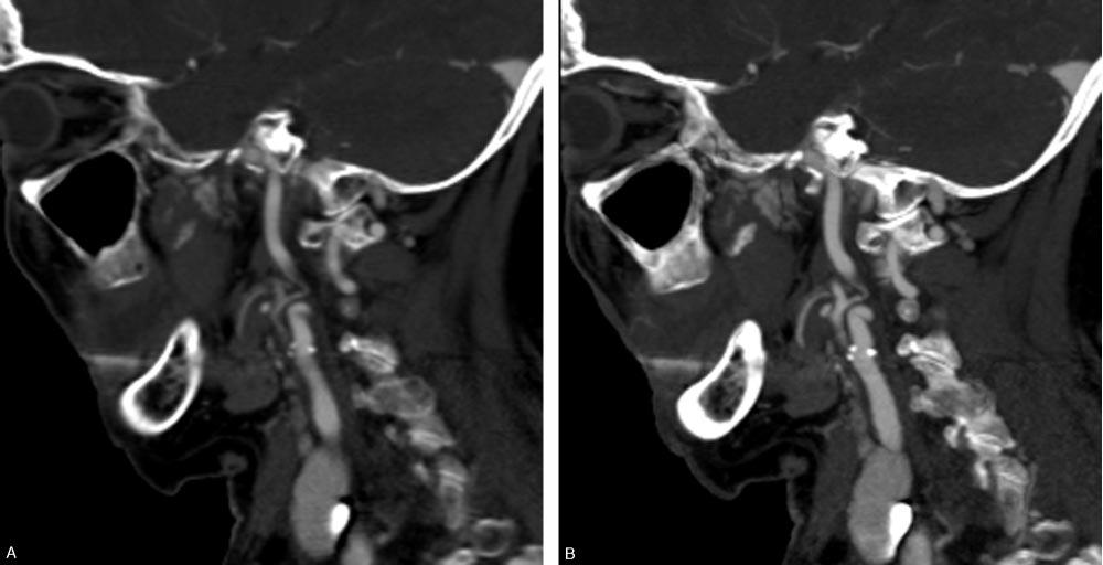 Window and level settings were standardized and are the same in both panels. Fig 3. Corresponding sagittal of STS MPR (A) and MIP (B) reformations in a 78-year-old woman.