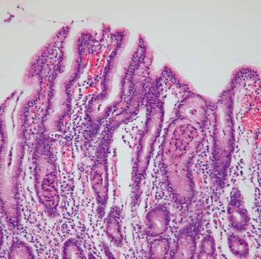 Clinicopathologic Analysis of Lymphocytic Gastritis 291 A B C D Fig. 1. Microscopic findings of LG.