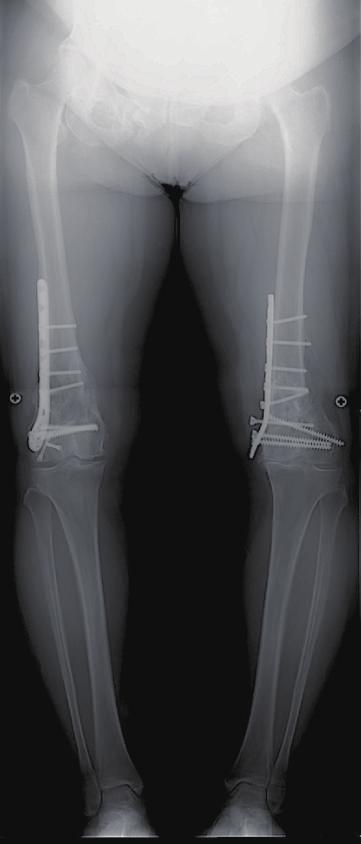 4 Case Reports in Orthopedics R R (d) (b) (h) L L (e) (a) (c) (f) (g) (i) Figure 3: Case 2: preoperative anteroposterior standing radiograph (a) showed both malunited supracondylar fracture with