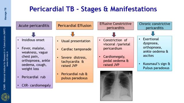 (Refer Slide Time: 08:33) So, the various stages and manifestations in pericardial TB; Pericardial TB can present as acute pericarditis, which is of insidious onset with fever, malaise, weakness,