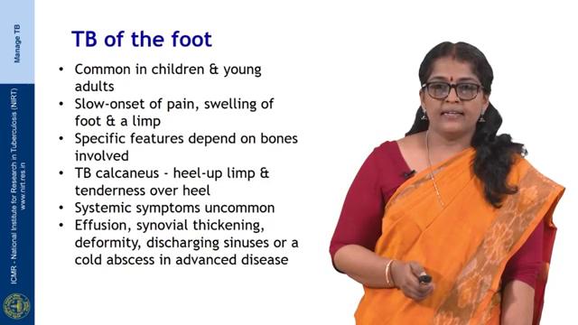 TB of the ankle joint; this commonly affects children and young adults, the slow onset painful swollen ankle with pain on weight bearing, which causes a limp.