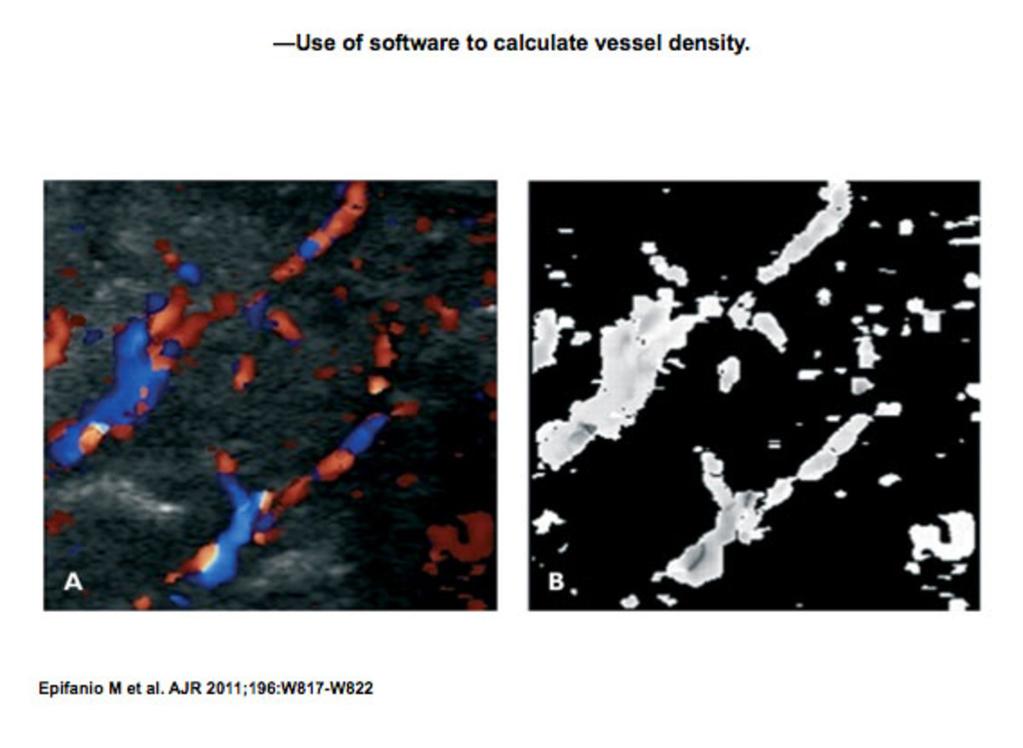 Fig. 2: -Use of software to calculate vessel density.