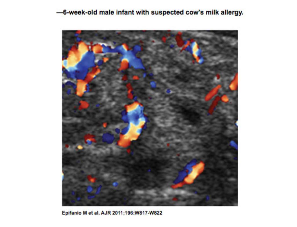 Fig. 5: -6-week-old male infant with suspected cow's milk allergy. Allergy is suspected because patient presented with symptoms of irritability, vomiting, severe food refusal, and poor weight gain.