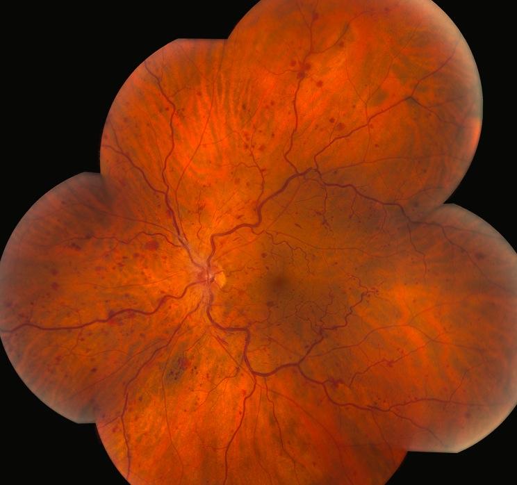 Central Retinal Vein Occlusion 78 yr old female