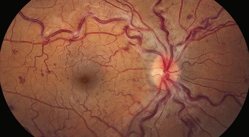 Central Retinal Vein Occlusion 39 yr old patient Do you initiate a