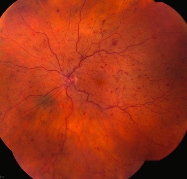 Central Retinal Vein Occlusion Do you ever use combination therapy with CRVO?