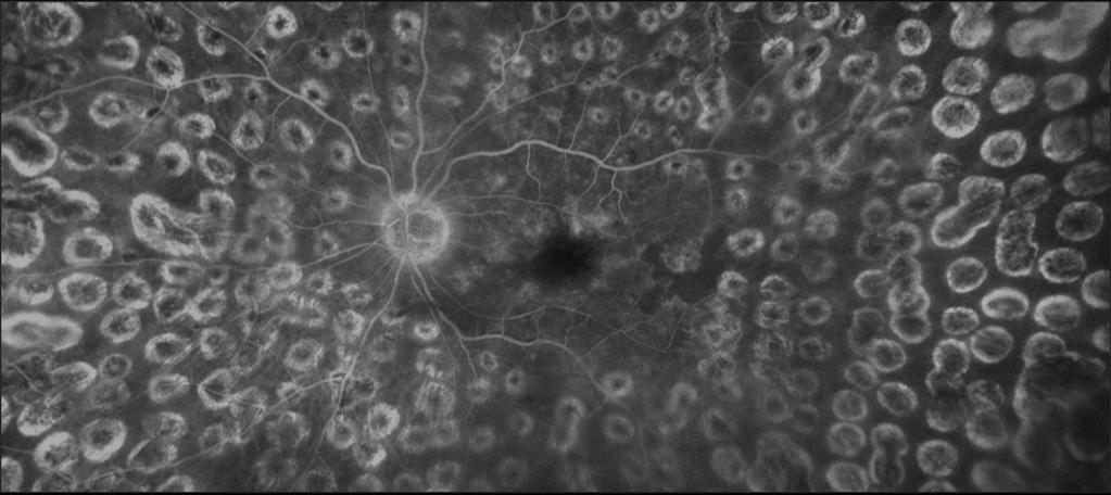 Central Retinal Vein Occlusion and Rubeosis If an eye