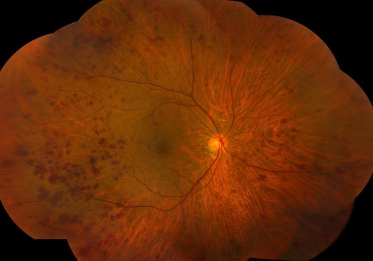 Ocular Ischemic Syndrome presenting as CRVO 75