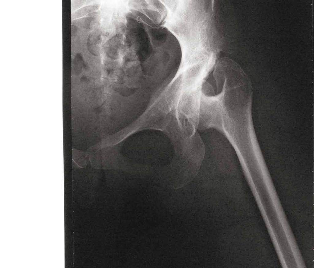 Following exposure of the proximal femur, the first cervical cut is made higher than the one planned, in order to remove the femoral head.