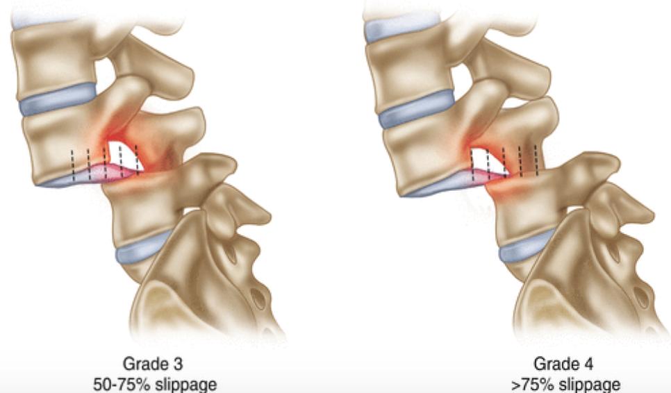 Spondylolysis develops through a crack or stress fracture in the pars