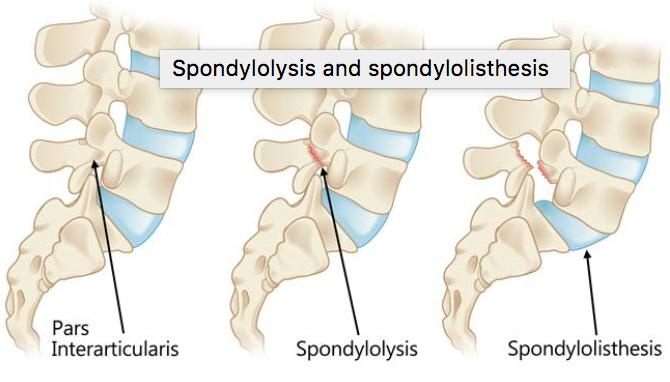 ("Spondylolysis and Spondylolisthesis.").