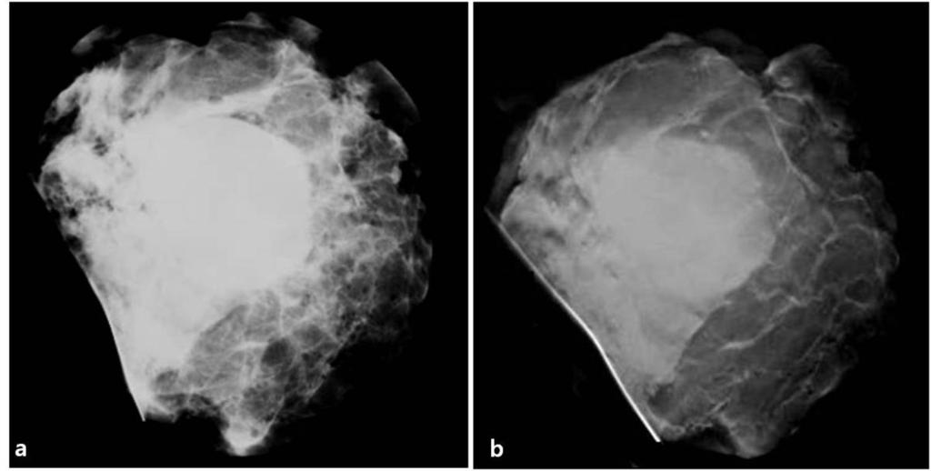 Fig. 3: A 63-year-old female with invasive ductal carcinoma (parenchymal pattern 2) who underwent breast-conserving surgery. The pathologically determined size of her cancer was 24 mm.