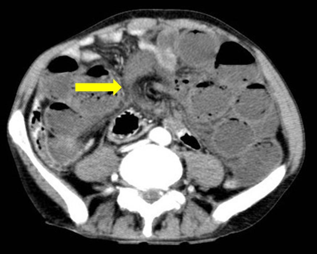 Fig. 1: Axial contrast-enhanced CT image shows the "whirl sign" (yellow