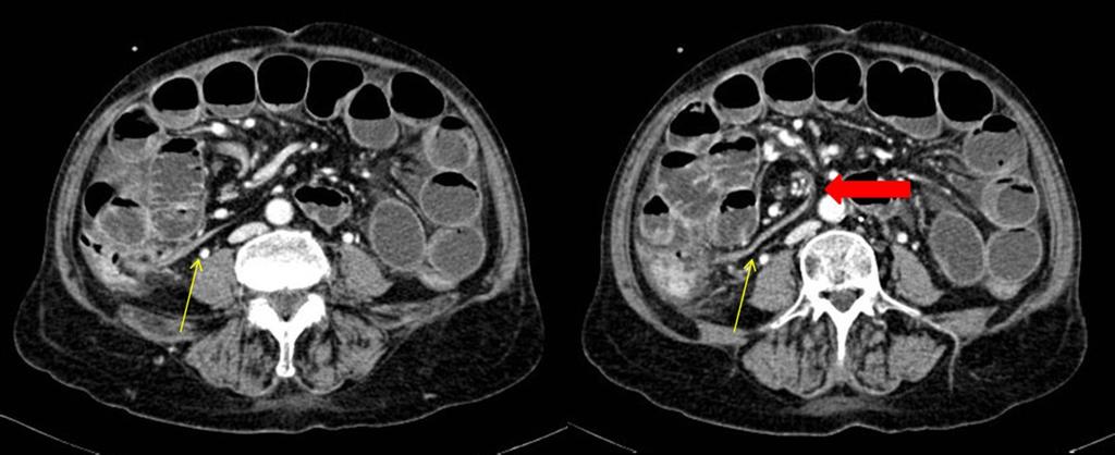 Fig. 2: Axial contrast-enhanced CT scan. Example of vascular "whirl" (red arrow), not included in the definition of "whirl sign".