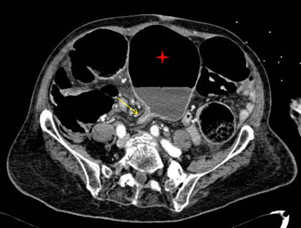Fig. 5: Axial contrast-enhanced CT image shows dilated sigmoid colon (red star) in a patient