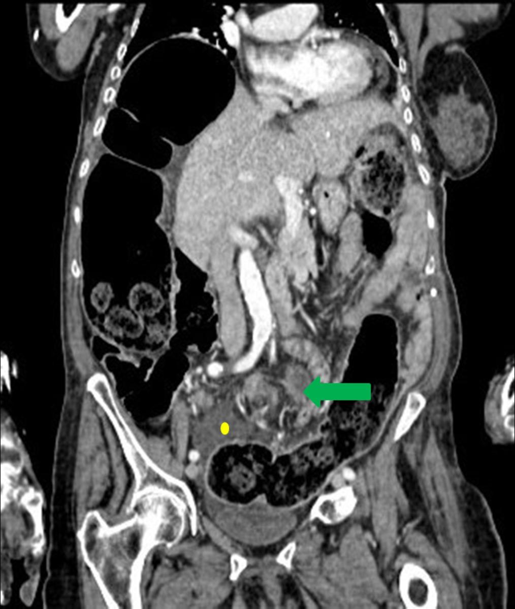 Fig. 6: Coronal CT scan of the same patient (fig 5). The "whirl sign" (green arrow) is best appreciated when the scanning plane is perpendicular to the axis of the twist, as it happens in this case.