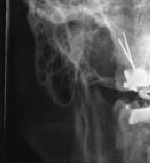 In cases of CCD with reduced osseous articulations and advanced imaging indicating soft tissue injury, the need for surgical intervention