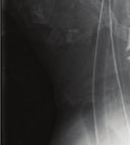 reported 16 cases of CCD after high-energy mechanisms and 6 deaths with high cervical spinal cord transections.