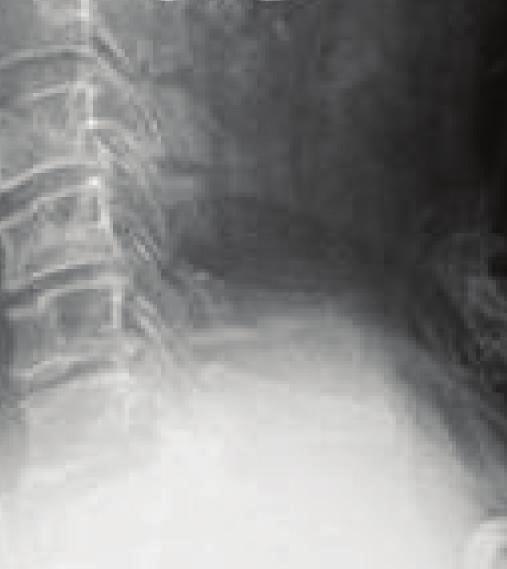 Distracted Type II dens fractures in highenergy trauma patients are one such indication.