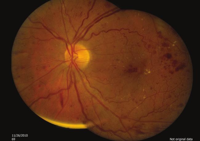 TREATMENT OPTIONS FOR DME By Michael D.Ober, MD CASE STUDY PRESENTATION A 54-year-old woman with poorly controlled diabetes presented in November 2010 with initial visual acuity of 20/80-.
