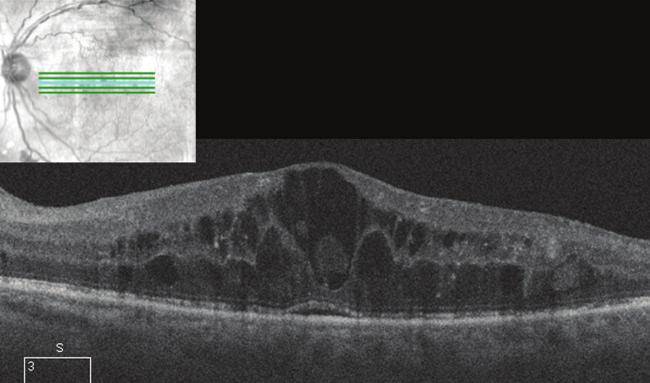 Angiography showed several areas of capillary drop-out and findings of early proliferative diabetic retinopathy were confirmed.