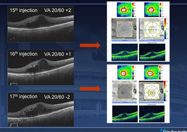 CASE STUDY PRESENTATION TREATMENT OPTIONS AND BEST RESPONSE By Rishi Singh, MD This female patient presented with nonproliferative diabetic retinopathy (NPDR) with clinically significant macular