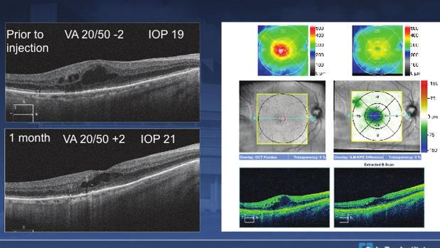 There was 1 focal laser treatment administered in May 2013. Optical coherence tomography (OCT) demonstrated continued CSME, despite multiple injections and focal treatment in the right eye.
