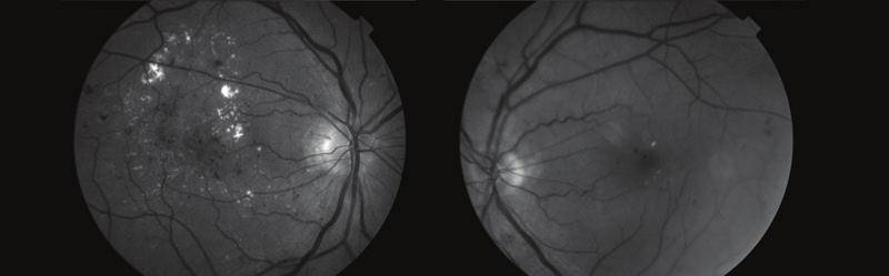 DME AND INTRAVITREAL CORTICOSTEROIDS By SriniVas R. Sadda, MD CASE STUDY PRESENTATION A 60-year-old female with decreased vision OD is referred for persistent macular edema.