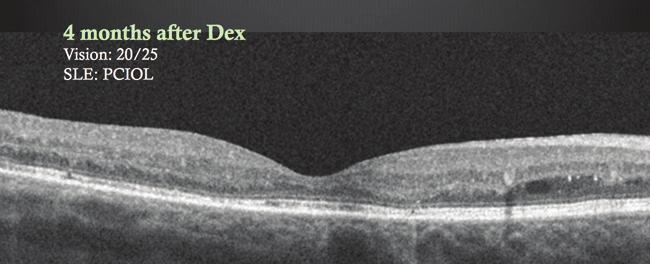 Her ocular history includes nonproliferative diabetic retinopathy bilaterally, clinically significant macular edema OD treated with focal laser twice, and has been given 3 intravitreal bevacizumab