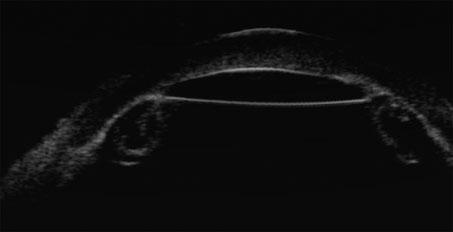 High-frequency annular arrays, linear arrays for imaging without probe movement, are under investigation. An 80-MHz UBM (iscience, iultrasound) has been used to image the Schlemm s canal.