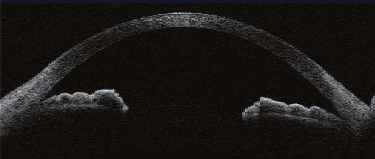 Figure 7: UBM image showing ary angle closure in an eye with drug-induced uveal effusion (blue asterisk). Figure 8: Depicts the normal anterior segment as imaged with ASOCT.