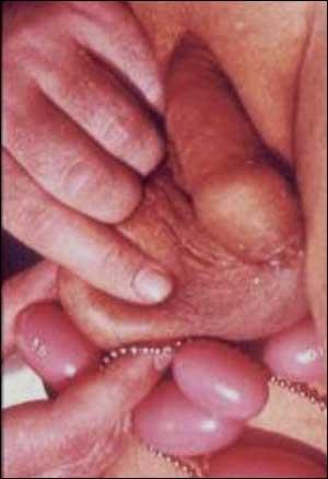 Testicular examination - testicular volume is estimated with caliper (Prader