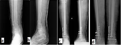 However use of expert tibial nail is more complicated as compared to normal tibial nail.