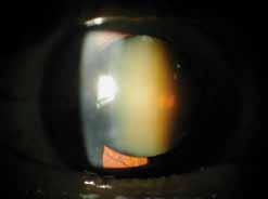 The type of cataract does not usually improve the way the cataract surgery is performed (except in very advanced forms of cataract).