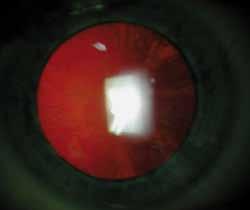 Eye Study. Apart from increased age, the other known strong association lies between ultraviolet B exposure and the development of cortical cataract.