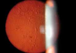 It is well known that corticosteroid use, diabetes mellitus and trauma are associated with posterior subcapsular cataract formation. Prevention strategies are listed in Table 1. Treatment Figure 1.
