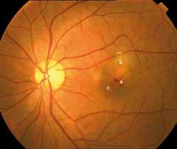 Wet ARMD (10 15% of cases) (Figure 7) refers to the development of a choroidal neovascular membrane underlying the RPE.