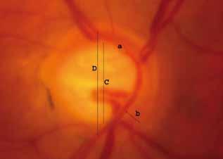 Features suggestive of glaucoma include progressive changes in the appearance of the optic nerve and visual field.