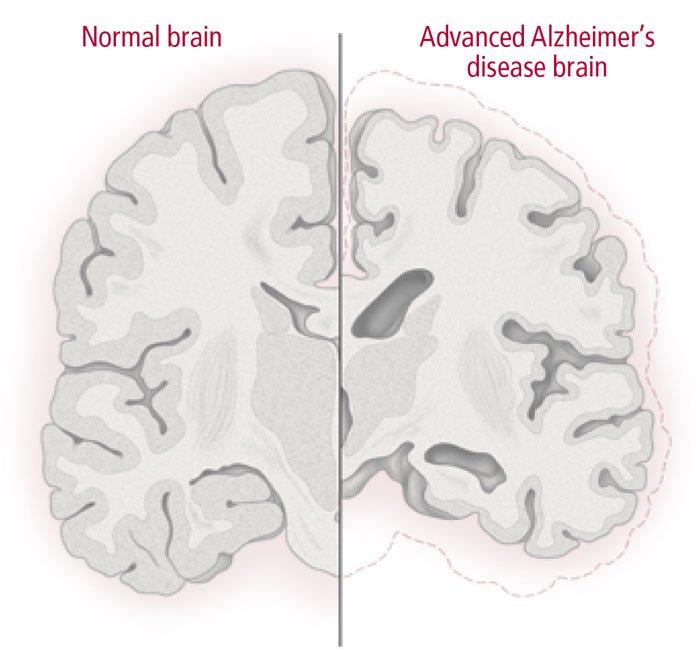 Although such lesions may be present in any aging brain, in people with Alzheimer s these lesions tend to be more numerous and accumulate in areas of the brain