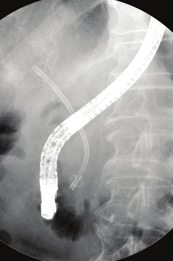 4 Diagnostic and Therapeutic Endoscopy (a) (b) Figure 2: ERCP shows malfunctioning DLS migration at 198 days after placement.