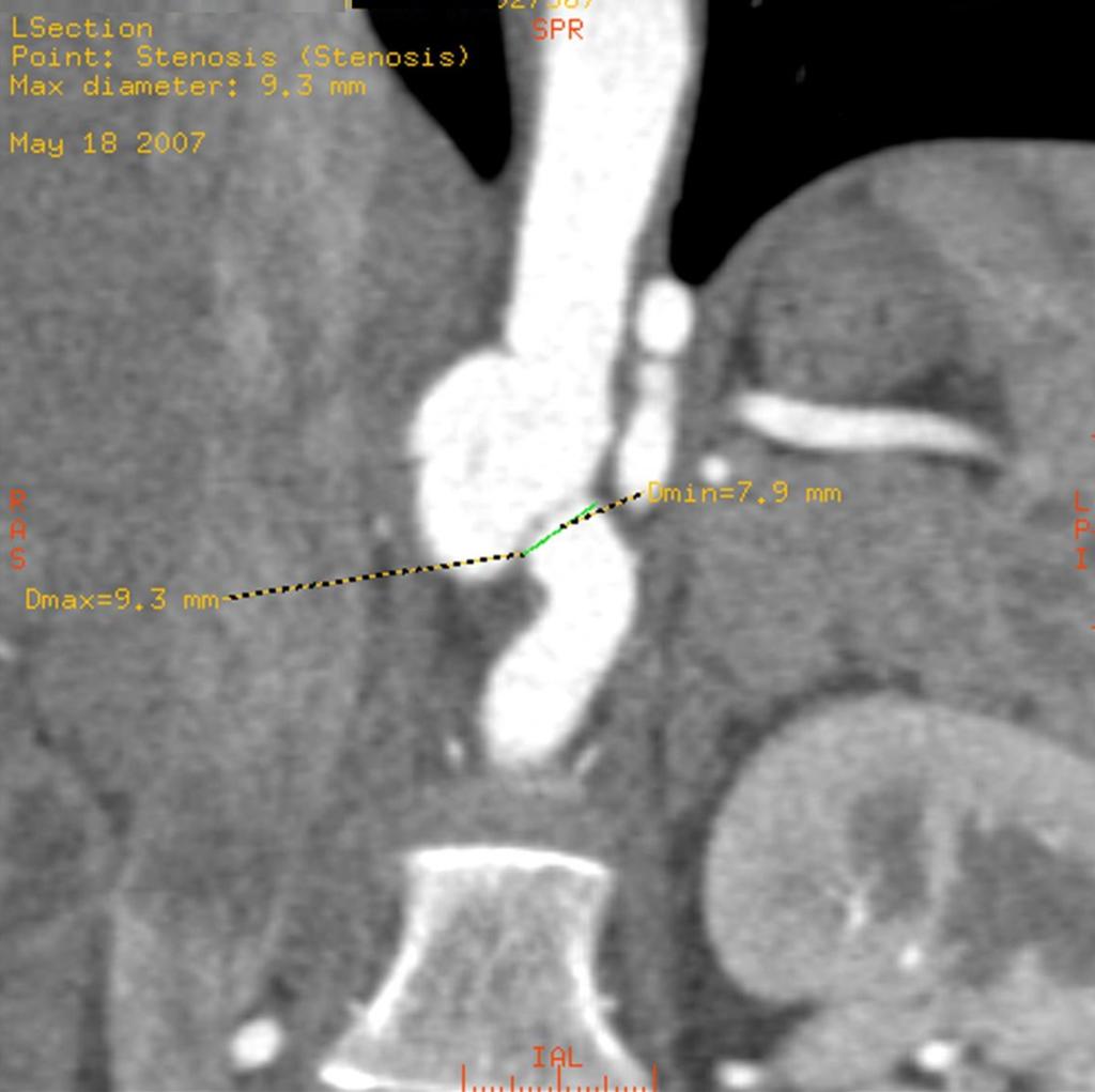 Fig. 7: Image with a fusiform poli-lobed eccentric aneurysm