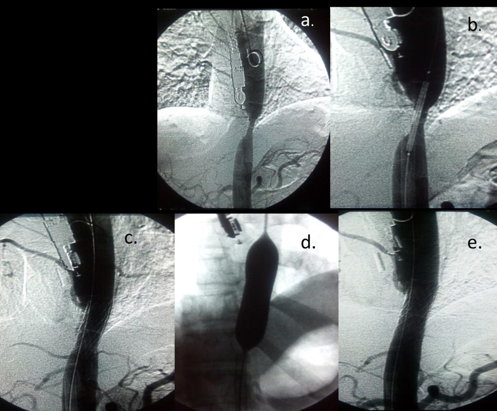 Images for this section: Fig. 11: Case 3. 35 years old man. Angiography where a severe stenosis distal thoracic aorta is seen (a).